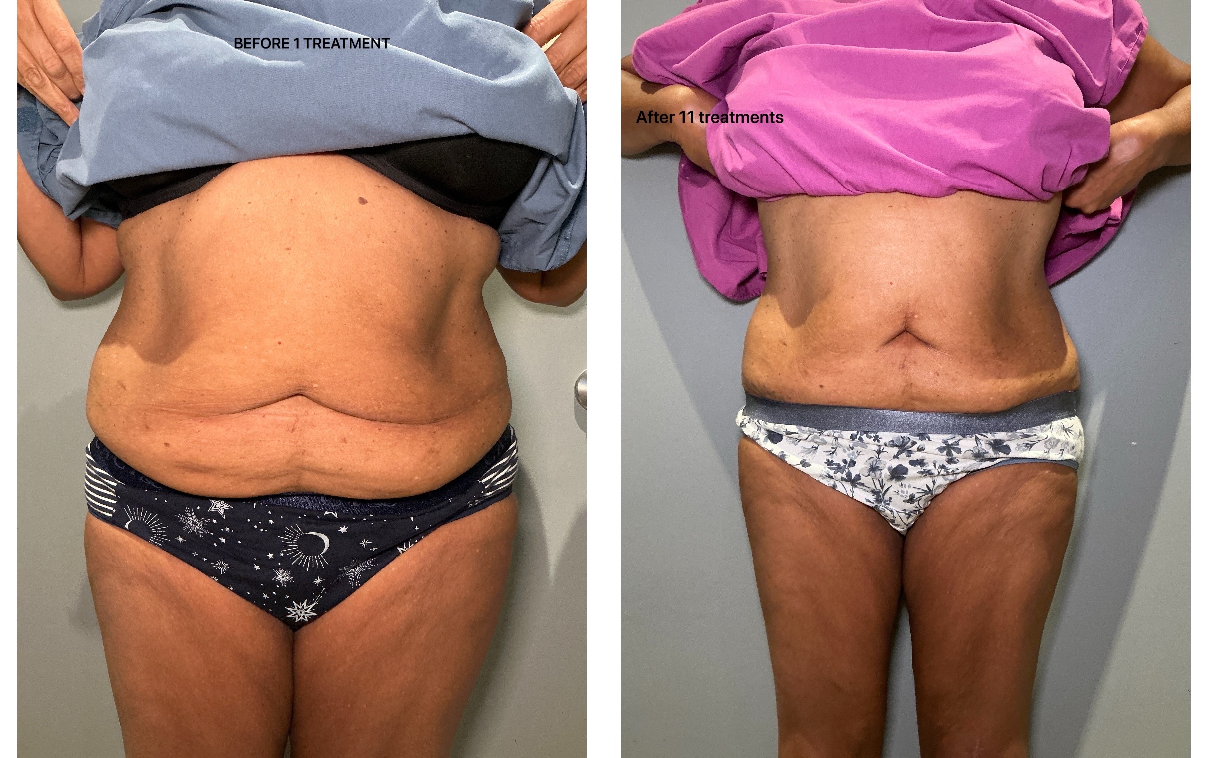 T-Shape 2 before and after — After 11 Treatments