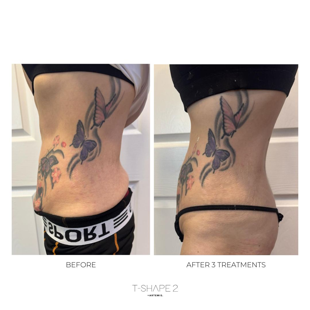 T-Shape 2 before and after — After 3 Treatments